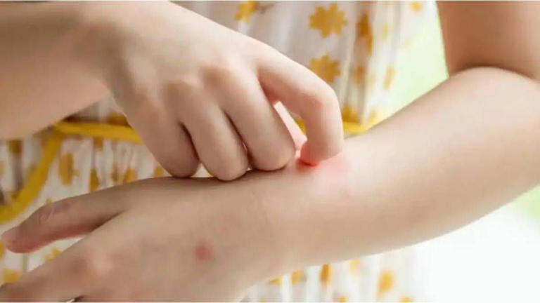 Inteligencia Artificial revela receta para repelente casero contra el dengue