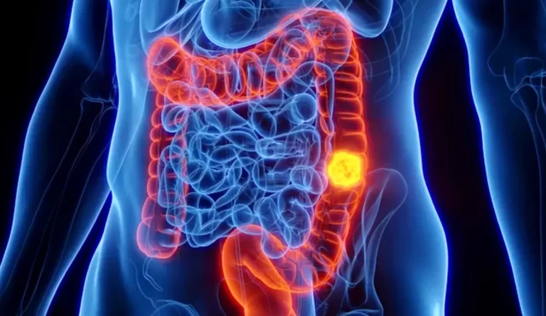 Alerta sanitaria: cáncer colorrectal en Argentina, una realidad que requiere atención urgente