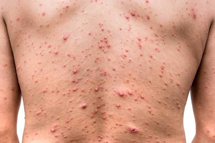 China: refuerzan protocolos por el aumento de casos de viruela del mono