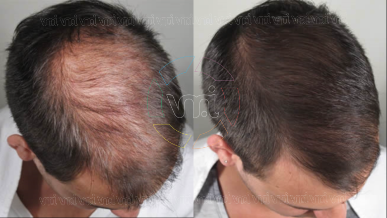 Implante capilar en Villa Mercedes: tecnología médica y un equipo especializado devuelven soluciones reales